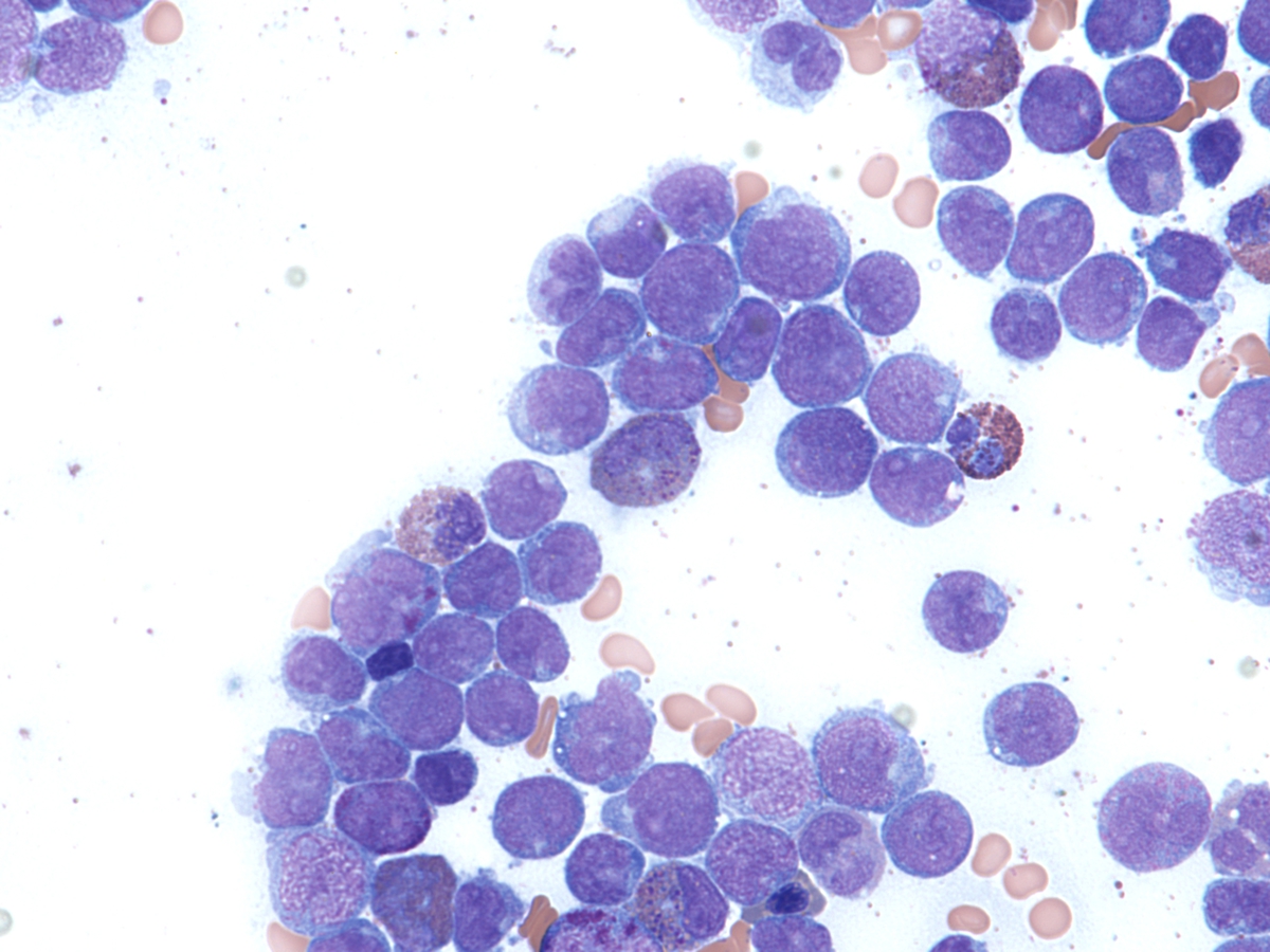 bone marrow aspirate with blasts, 60x, 1 month after gastric biopsy